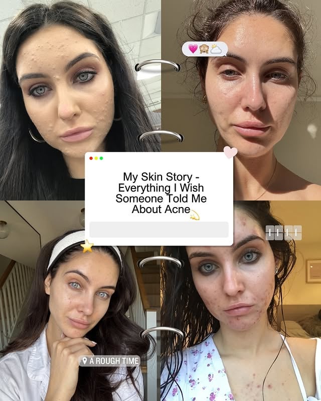 Your Skin isn’t failing you 🫶🏼✨ nearly 20 years after my first dr visit for acne at 14 here we are still struggling with it but with a hell of a lot more knowledge and understanding 🤍 a few more breakouts recently after stopping topical tretinoin but you guys gave me sooo many products to try and I’m slowly working through them 🫶🏼 we got this xx by @sophiemoulds